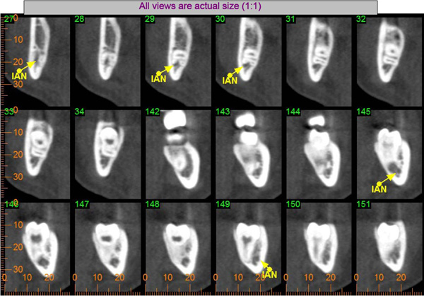 extraction of impacted tooth image 2