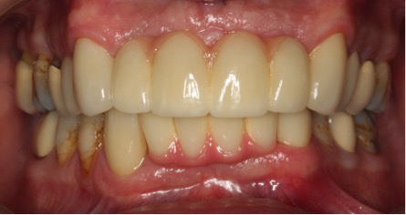 after pic of replacing teeth